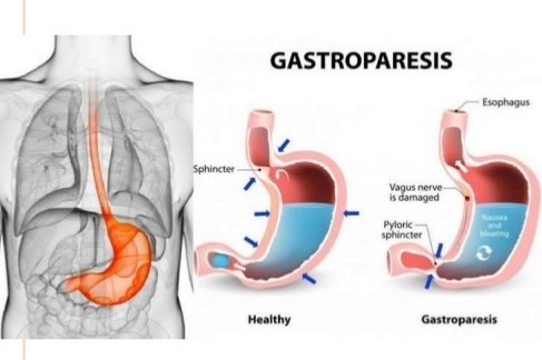 gastropresis therapy